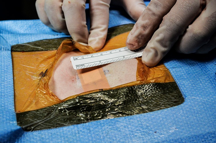 Laser-Spine-Surgery-One-Inch-Incision Laser-Spine-Surgery-One-Inch-Incision