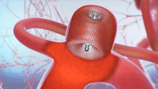 Web-in-aneurysm