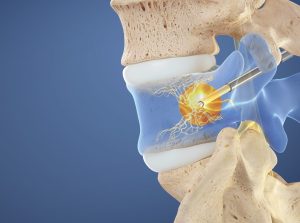 interventional pain, spine graphic